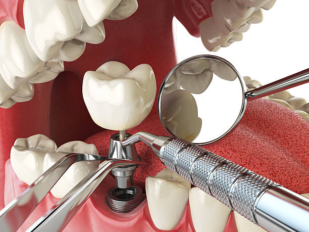 Best Emergency Broken Tooth Repair in Hardinsburg, KY